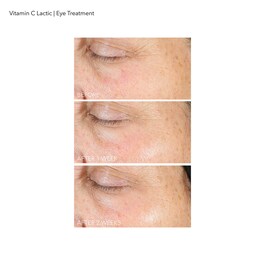 Vitamina C Lactic - Trattamento Contorno Occhi Luminoso