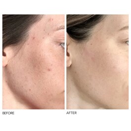 Alpha Beta® - Peeling quotidiano a formula universale