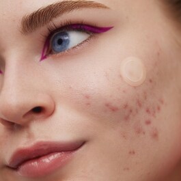 Cerotti per il trattamento dell'acne - Microneedling