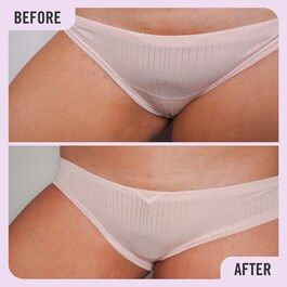 Ingrown Hair Pads - Dischetti per peli incarniti con AHA+ BHA