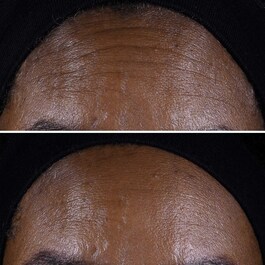 Smart Clinical Repair Lifting Face + Neck Cream - Micro-Lift Moisturizer 