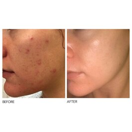 Alpha Beta® - Peeling quotidiano a formula intensiva