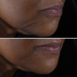 Smart Clinical Repair Lifting Face + Neck Cream - Micro-Lift Moisturizer 