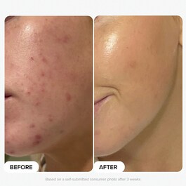 Multi-Level Exfoliation Trial Kit - Discovery Set con esfolianti AHA + BHA