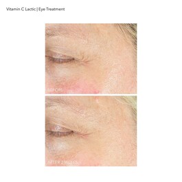 Vitamina C Lactic - Trattamento Contorno Occhi Luminoso