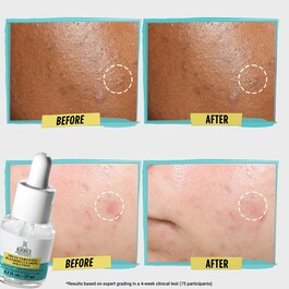 Truly targeted acne clearing solution - patch liquido anti imperfezioni