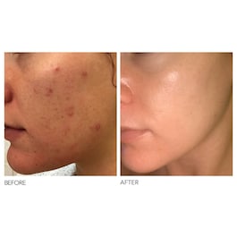 Alpha Beta® - Peeling quotidiano a formula intensiva