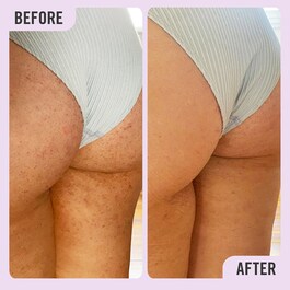 KP Bump Eraser Body Scrub with 10% AHA - Scrub corpo con AHA