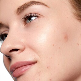 Acne Day Dot - Patch anti-imperfezioni