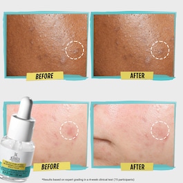 Truly targeted acne clearing solution - patch liquido anti imperfezioni