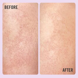 KP Bump Eraser Body Scrub with 10% AHA - Scrub corpo con AHA