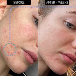 Blemish Clearing Moisturizer 2% NovoRetin - Crema idratante per la notte