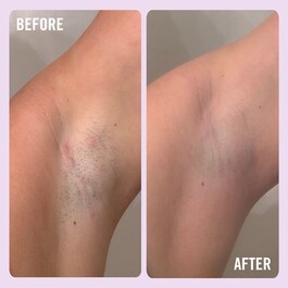 Ingrown Hair Pads - Dischetti per peli incarniti con AHA+ BHA