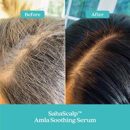 Kit rigenerazione cuoio capelluto SahaScalp™ - Cofanetto trattamenti capillari