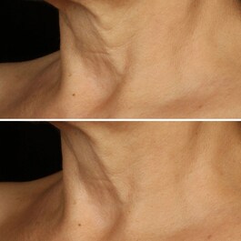 Smart Clinical Repair Lifting Face + Neck Cream - Micro-Lift Moisturizer 