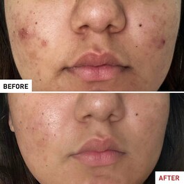 CENTELLA ACNE CARE - FLUIDO LENITIVO
